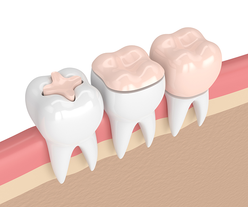 Happy Smiles Dentistry of Westchester | Preventive Dental Care, Sealants and Myobrace